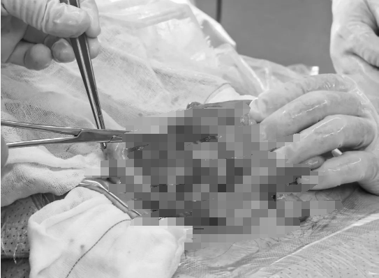 新春“首战”告捷！济南南郊医院普外科成功救治乙状结肠坏死穿孔患者